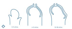 postoperatorio circuncisin fotos|Recuperación tras Fimosis, antes y después